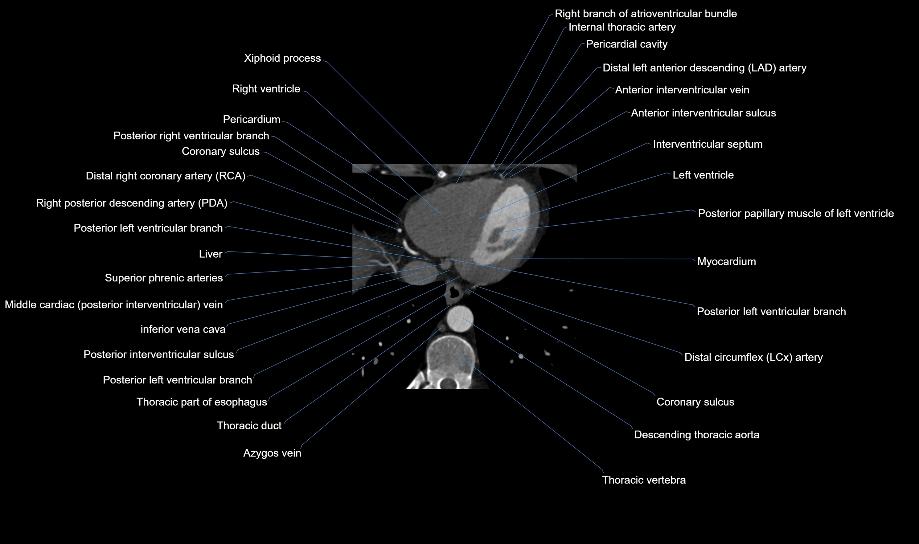CT heart (coronary angiogram) axial view cross sectional anatomy labelled radiology image-00057.webp